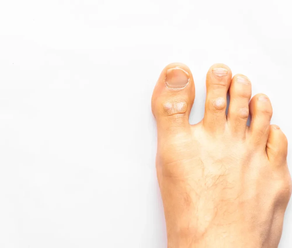 Accompagnement hallux valgus (oignon du pied) – Delcros